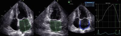 Progressive alterations of left atrial and ventricular volume and strain across chronic kidney disease stages: a speckle tracking echocardiography study
